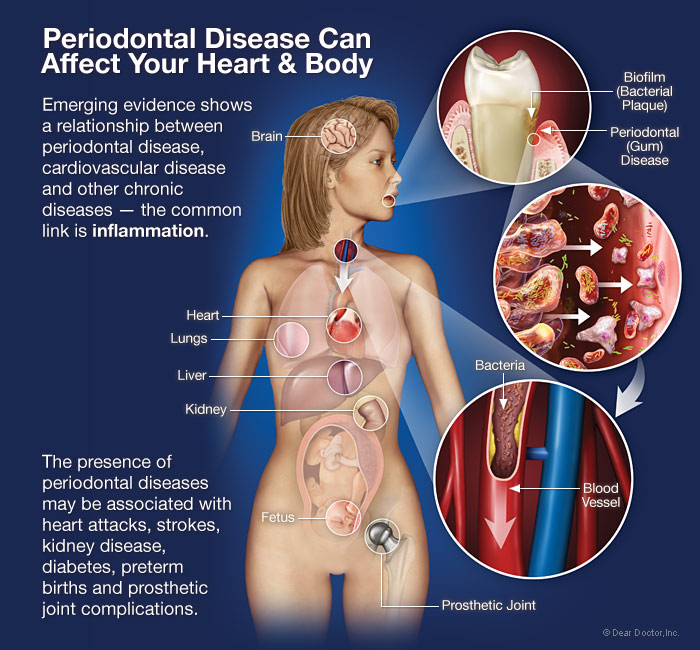 Periodontal Disease Can Affect Your Heart & Body