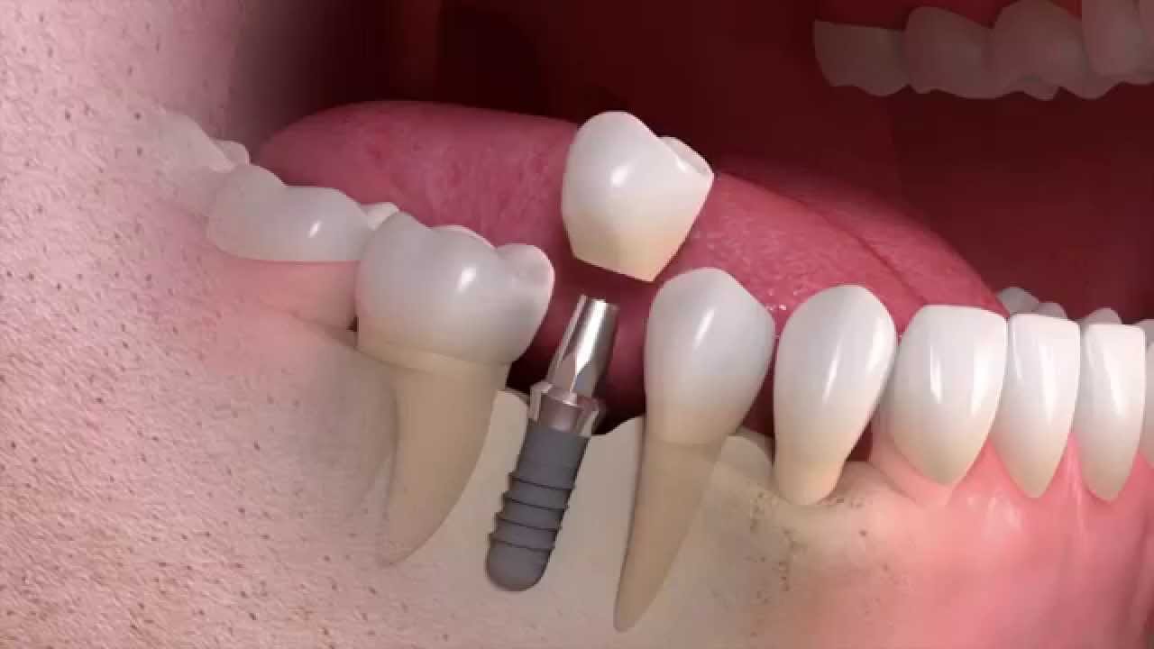 Diagram of a single tooth implant single implant
