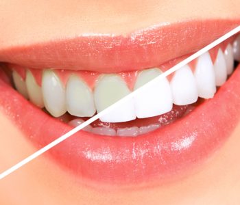 teeth-whitening