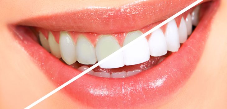 teeth-whitening