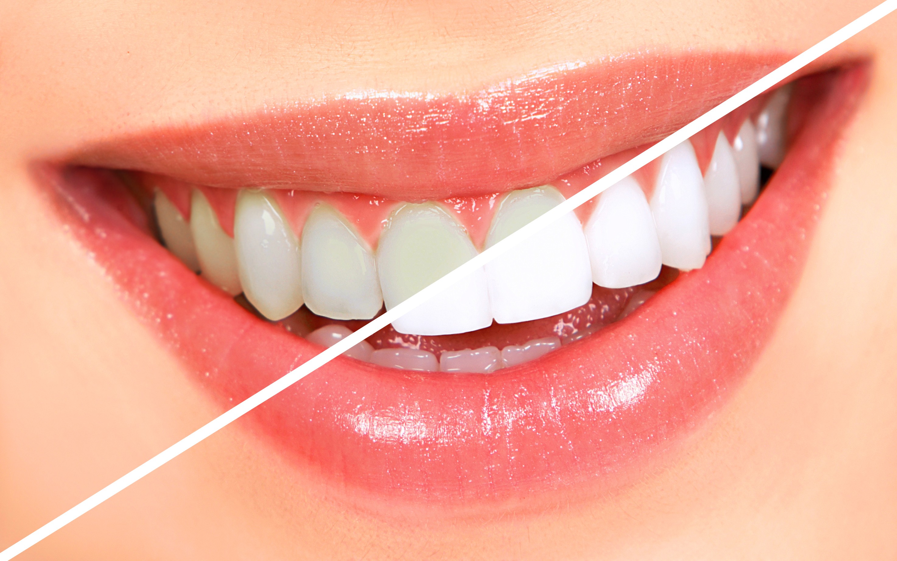 Diktatur Metal linje Withered How to Get Whiter Teeth Just In Time for the Holidays