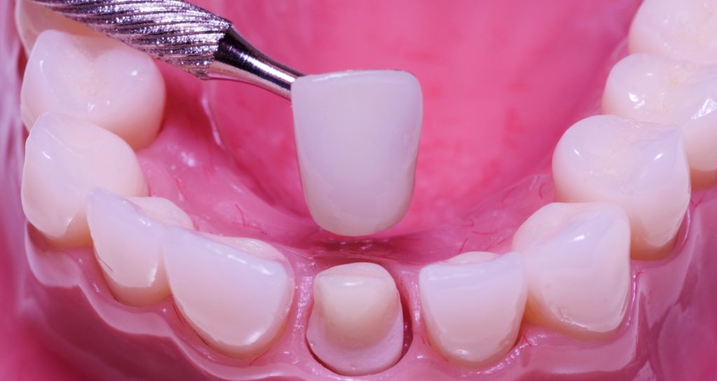 patient getting dental crown