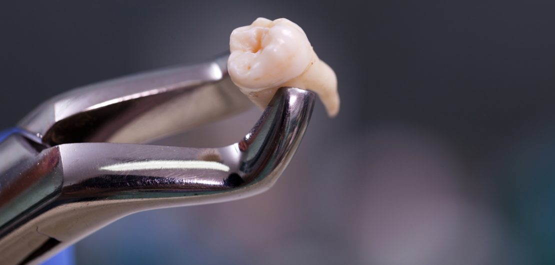 How are teeth pulled? What happens when a tooth is pulled?