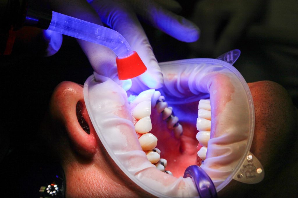 UV light curing on teeth at the dentist