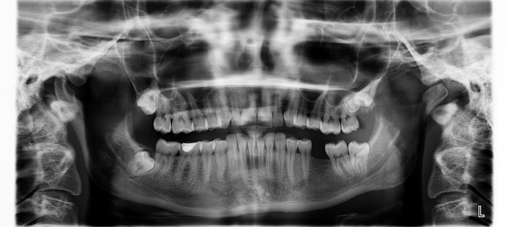 Xray of a mouth missing a tooth