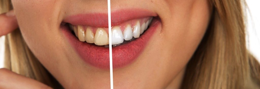 Teeth whitening before and after