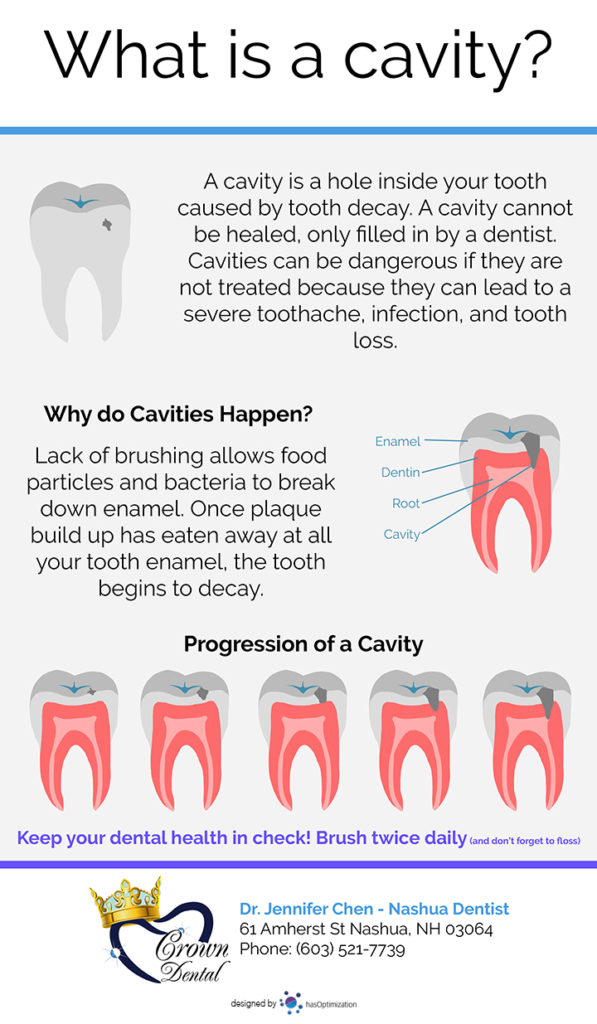 What is a cavity Infographic