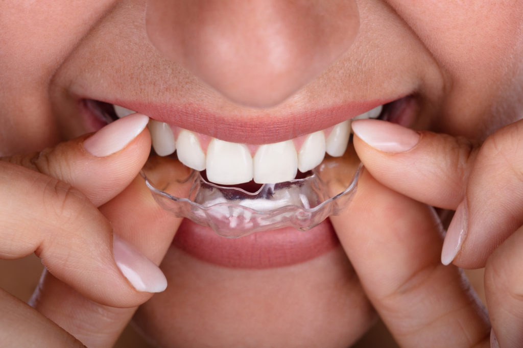 Clear Aligners Vs Braces Which Is Best For Me Which Is Better 