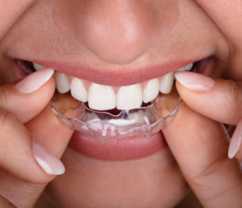 Woman Putting Transparent Aligner In Teeth