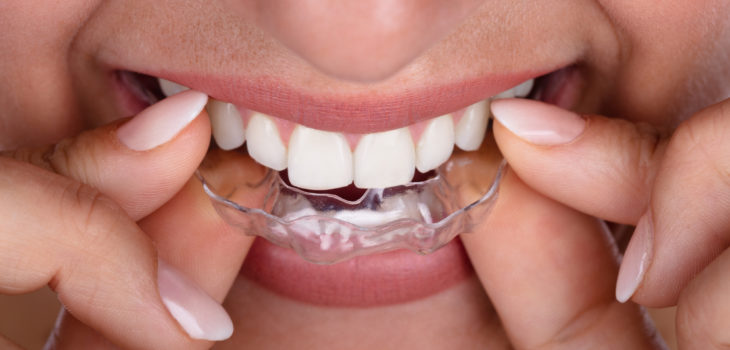 Woman Putting Transparent Aligner In Teeth